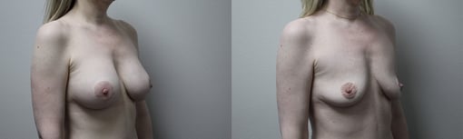 implant removal before and after photos by kryger institute of plastic surgery in thousand oaks ca