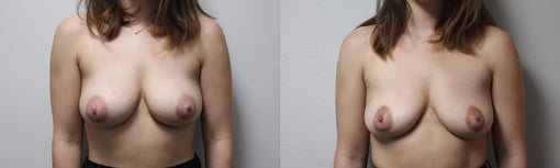 implant removal before and after photos by kryger institute of plastic surgery in thousand oaks ca