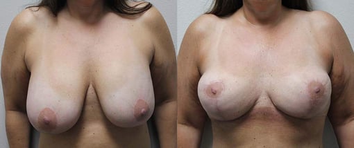 implant removal before and after photos by kryger institute of plastic surgery in thousand oaks ca