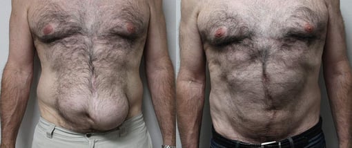 hernia repair before and after photos by kryger institute of plastic surgery in thousand oaks ca