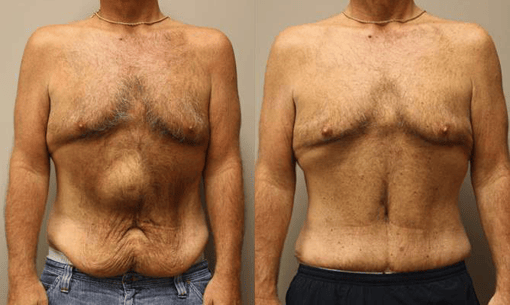 hernia repair before and after photos by kryger institute of plastic surgery in thousand oaks ca