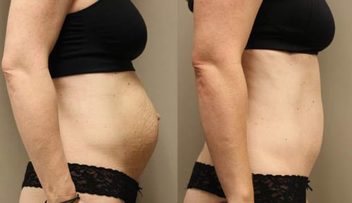 hernia repair before and after photos by kryger institute of plastic surgery in thousand oaks ca