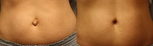 hernia repair before and after photos by kryger institute of plastic surgery in thousand oaks ca