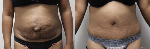 hernia repair before and after photos by kryger institute of plastic surgery in thousand oaks ca