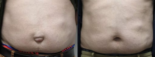 hernia repair before and after photos by kryger institute of plastic surgery in thousand oaks ca