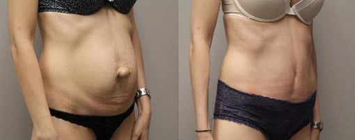 hernia repair before and after photos by kryger institute of plastic surgery in thousand oaks ca