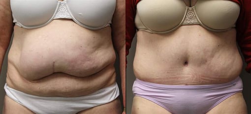hernia repair before and after photos by kryger institute of plastic surgery in thousand oaks ca