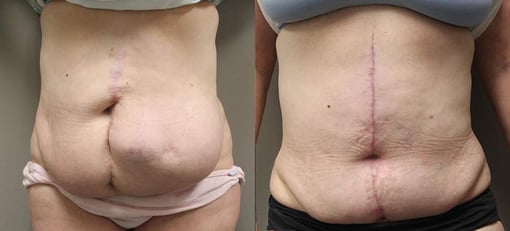 hernia repair before and after photos by kryger institute of plastic surgery in thousand oaks ca