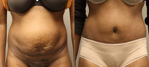 hernia repair before and after photos by kryger institute of plastic surgery in thousand oaks ca