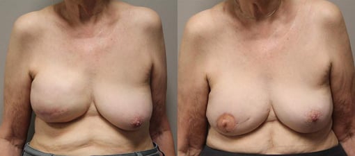 free tram flap reconstruction before and after photos by kryger institute of plastic surgery in thousand oaks ca