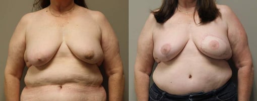 free tram flap reconstruction before and after photos by kryger institute of plastic surgery in thousand oaks ca