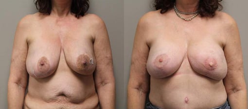 free tram flap reconstruction before and after photos by kryger institute of plastic surgery in thousand oaks ca