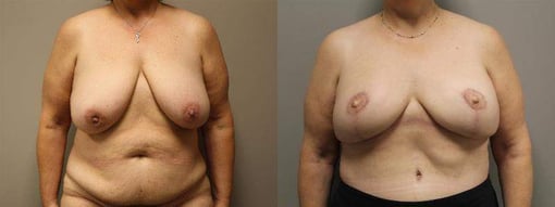 free tram flap reconstruction before and after photos by kryger institute of plastic surgery in thousand oaks ca