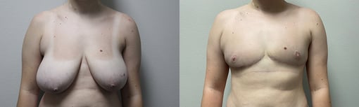 female to male transition before and after photos by kryger institute of plastic surgery in thousand oaks ca