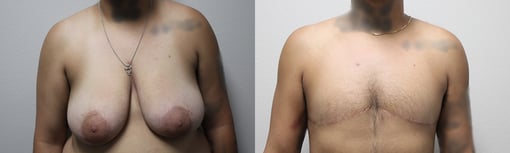 female to male transition before and after photos by kryger institute of plastic surgery in thousand oaks ca