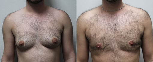 female to male transition before and after photos by kryger institute of plastic surgery in thousand oaks ca