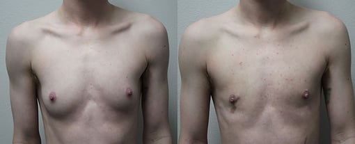 female to male transition before and after photos by kryger institute of plastic surgery in thousand oaks ca