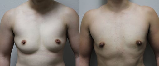 female to male transition before and after photos by kryger institute of plastic surgery in thousand oaks ca