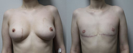 female to male transition before and after photos by kryger institute of plastic surgery in thousand oaks ca