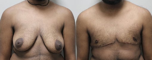 female to male transition before and after photos by kryger institute of plastic surgery in thousand oaks ca