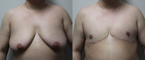 female to male transition before and after photos by kryger institute of plastic surgery in thousand oaks ca