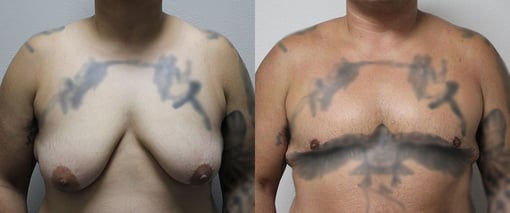 female to male transition before and after photos by kryger institute of plastic surgery in thousand oaks ca