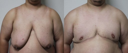 female to male transition before and after photos by kryger institute of plastic surgery in thousand oaks ca