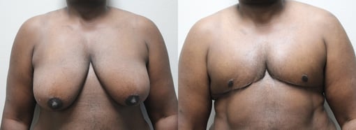 female to male transition before and after photos by kryger institute of plastic surgery in thousand oaks ca