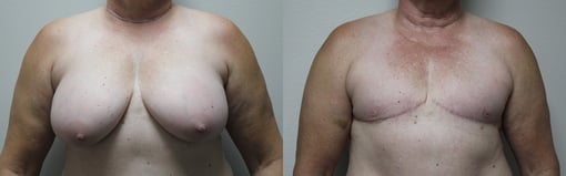 female to male transition before and after photos by kryger institute of plastic surgery in thousand oaks ca