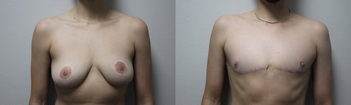 female to male transition before and after photos by kryger institute of plastic surgery in thousand oaks ca