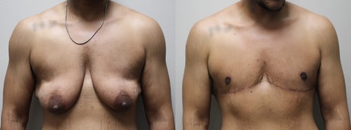 female to male transition before and after photos by kryger institute of plastic surgery in thousand oaks ca