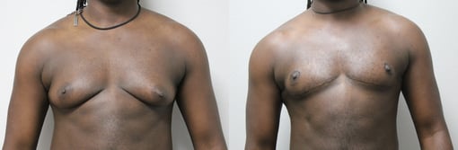female to male transition before and after photos by kryger institute of plastic surgery in thousand oaks ca