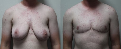 female to male transition before and after photos by kryger institute of plastic surgery in thousand oaks ca