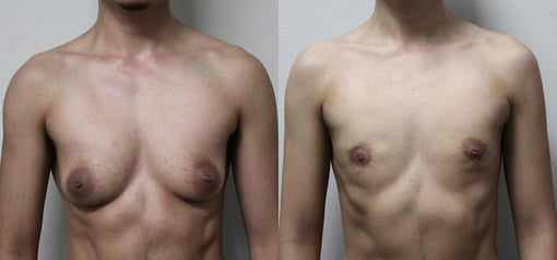 female to male transition before and after photos by kryger institute of plastic surgery in thousand oaks ca