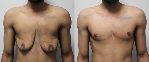 female to male transition before and after photos by kryger institute of plastic surgery in thousand oaks ca