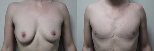 female to male transition before and after photos by kryger institute of plastic surgery in thousand oaks ca