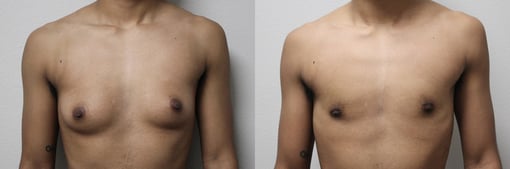 female to male transition before and after photos by kryger institute of plastic surgery in thousand oaks ca