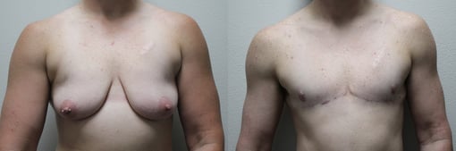 female to male transition before and after photos by kryger institute of plastic surgery in thousand oaks ca