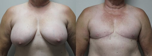 female to male transition before and after photos by kryger institute of plastic surgery in thousand oaks ca