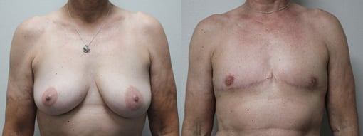 female to male transition before and after photos by kryger institute of plastic surgery in thousand oaks ca