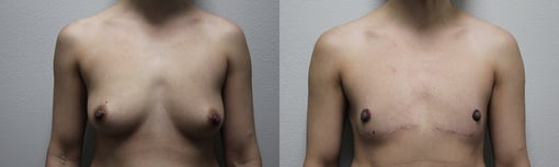 female to male transition before and after photos by kryger institute of plastic surgery in thousand oaks ca