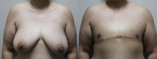 female to male transition before and after photos by kryger institute of plastic surgery in thousand oaks ca