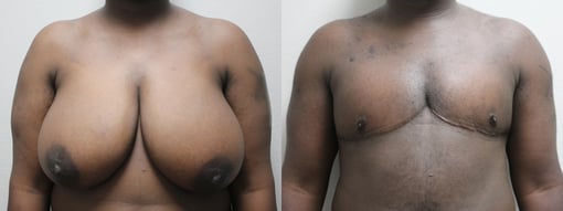 female to male transition before and after photos by kryger institute of plastic surgery in thousand oaks ca