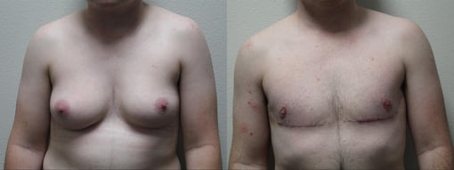 female to male transition before and after photos by kryger institute of plastic surgery in thousand oaks ca