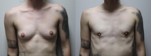 female to male transition before and after photos by kryger institute of plastic surgery in thousand oaks ca