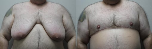 female to male transition before and after photos by kryger institute of plastic surgery in thousand oaks ca