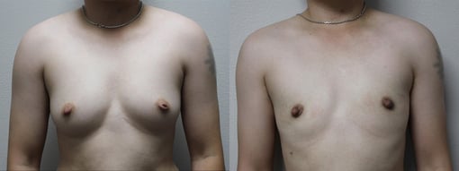 female to male transition before and after photos by kryger institute of plastic surgery in thousand oaks ca