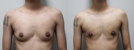 female to male transition before and after photos by kryger institute of plastic surgery in thousand oaks ca