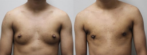 female to male transition before and after photos by kryger institute of plastic surgery in thousand oaks ca