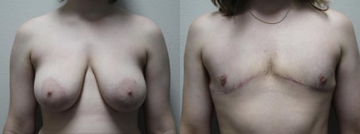female to male transition before and after photos by kryger institute of plastic surgery in thousand oaks ca